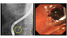 ERCP.jpg