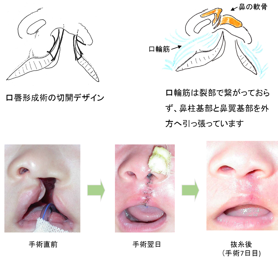 ☆安心の定価販売☆】 口唇裂・口蓋裂の治療:最近の進歩 健康/医学
