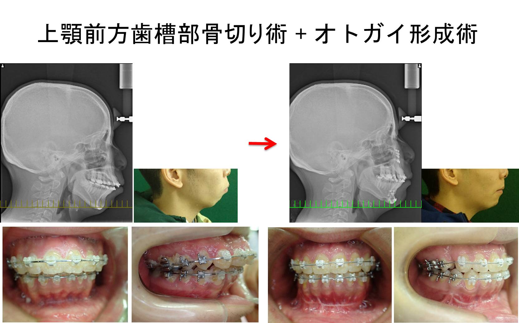 両顎手術の代替手段