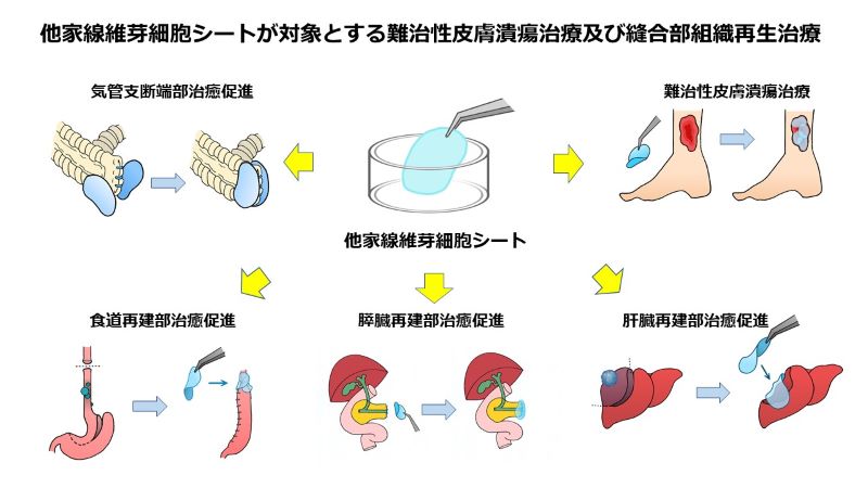 画像:他家線維芽細胞シートを用いた難治性皮膚潰瘍に対する再生医療法の図解